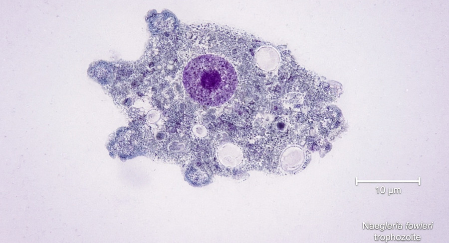 North Carolina Teen In Critical Condition After Contracting Rare Brain-Eating Amoeba